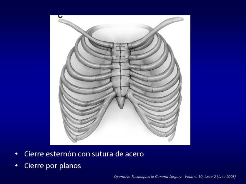 Diapositiva 20 de Toracotomías