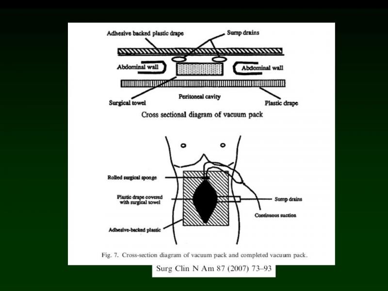 Diapositiva 35 de Trauma: Damage Control