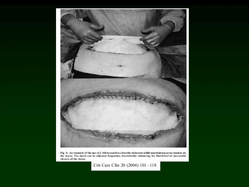 Diapositiva 33 de Trauma: Damage Control