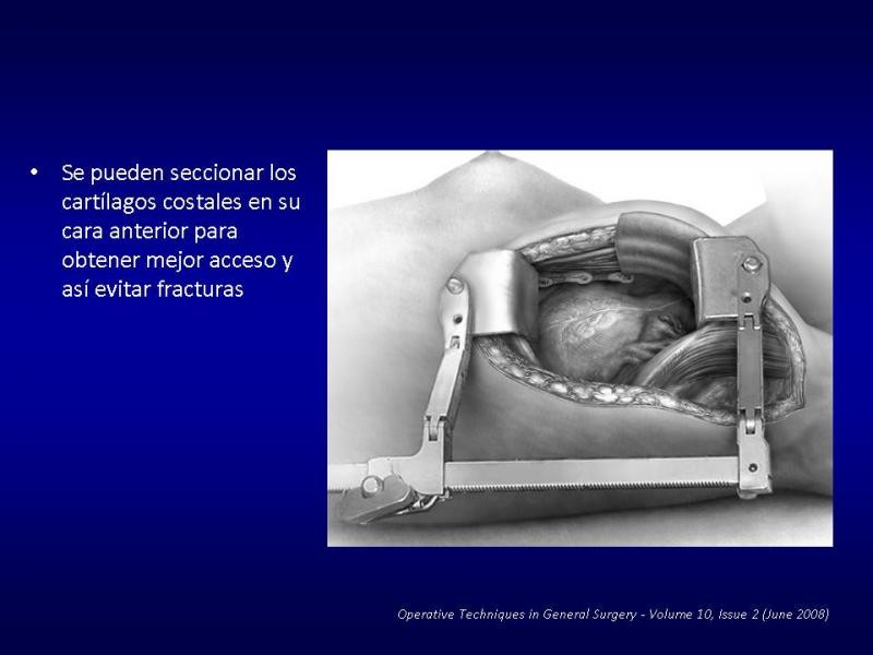 Diapositiva 7 de Toracotomías