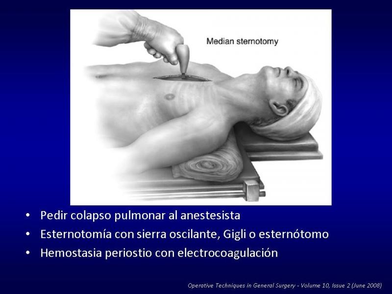Diapositiva 18 de Toracotomías