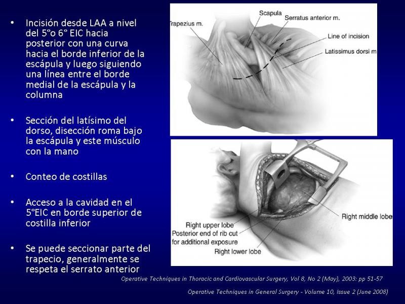 Diapositiva 13 de Toracotomías