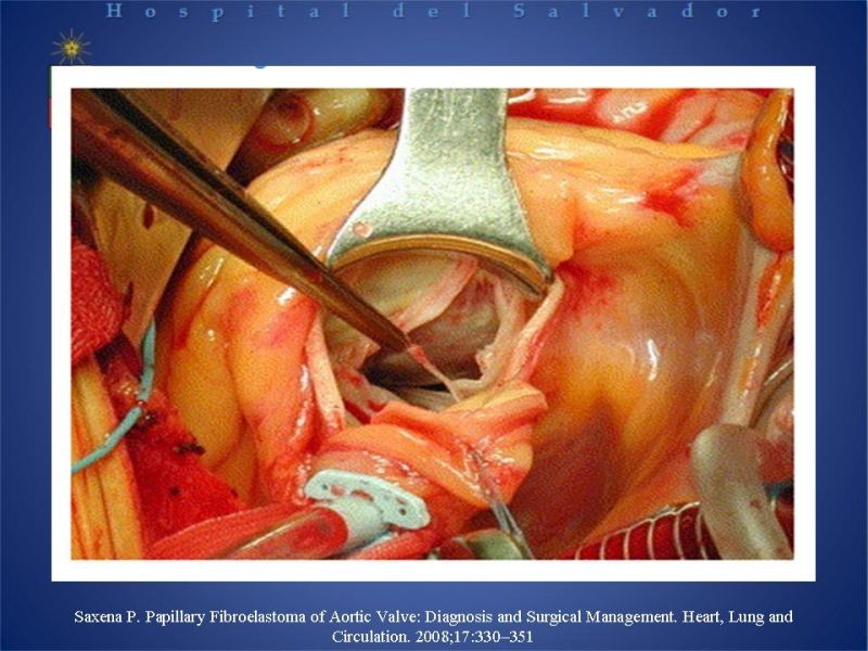 Diapositiva 21 de Tumores Cardiacos