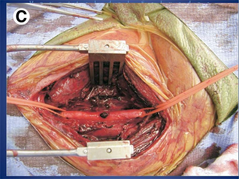 Diapositiva 22 de Trauma Vascular Cervical
