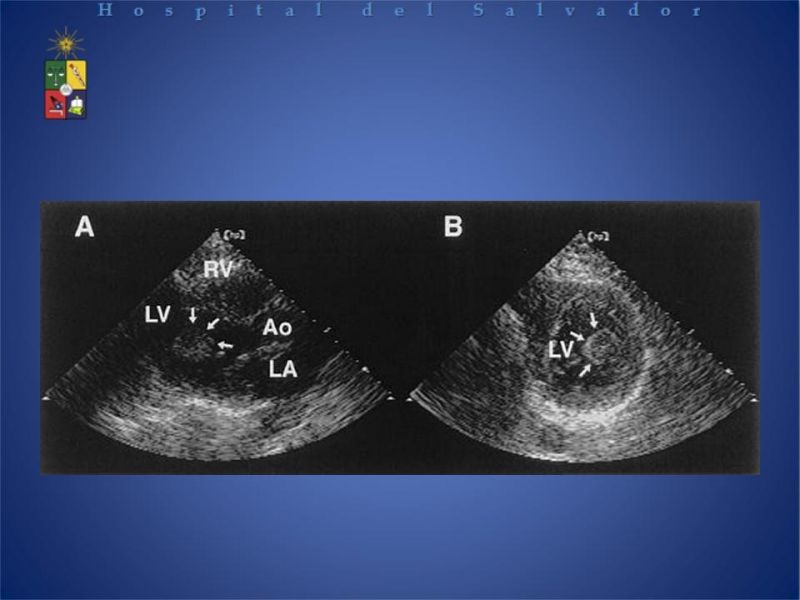 Diapositiva 22 de Tumores Cardiacos