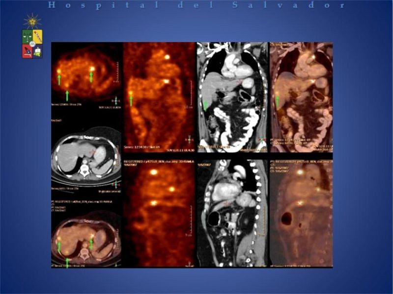 Diapositiva 18 de PET-CT en cáncer de Pulmón