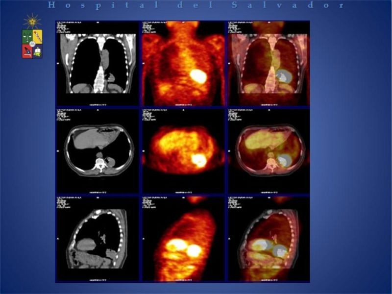 Diapositiva 3 de PET-CT en cáncer de Pulmón