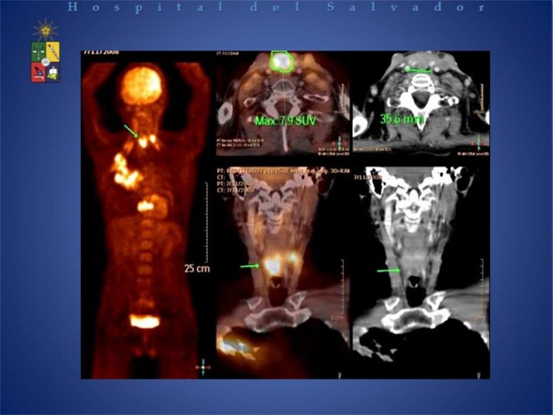 Diapositiva 19 de PET-CT en cáncer de Pulmón