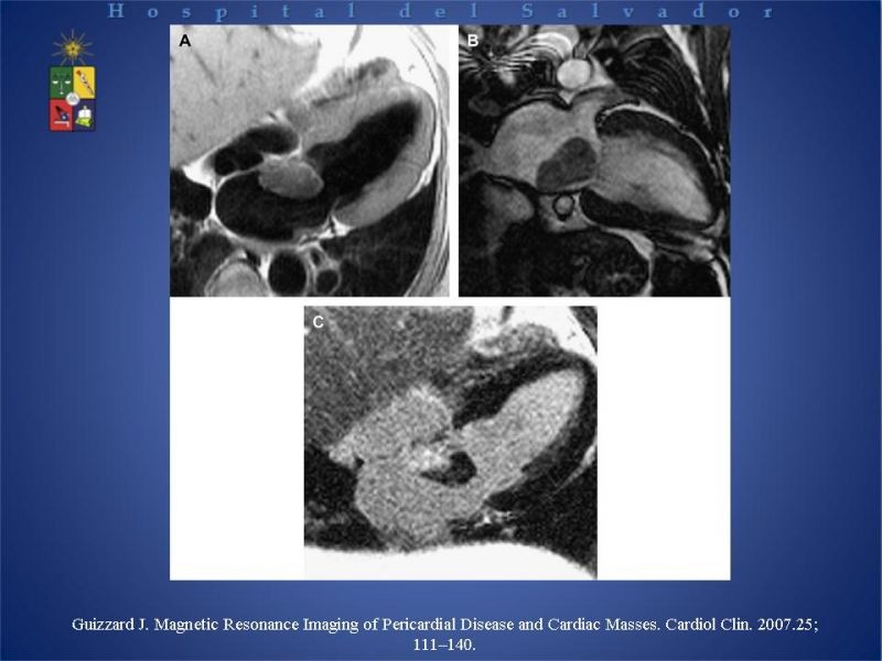 Diapositiva 13 de Tumores Cardiacos