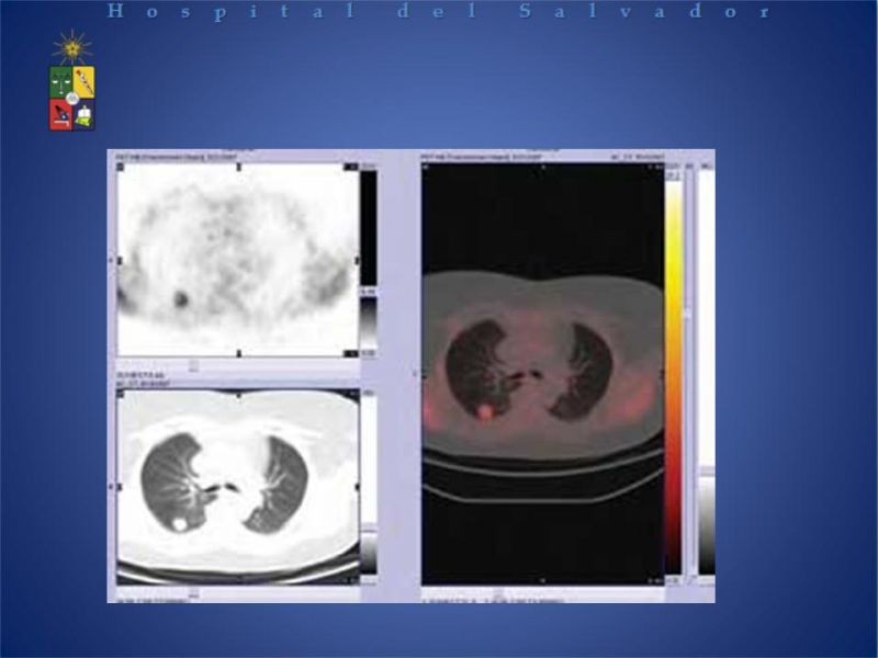 Diapositiva 11 de PET-CT en cáncer de Pulmón