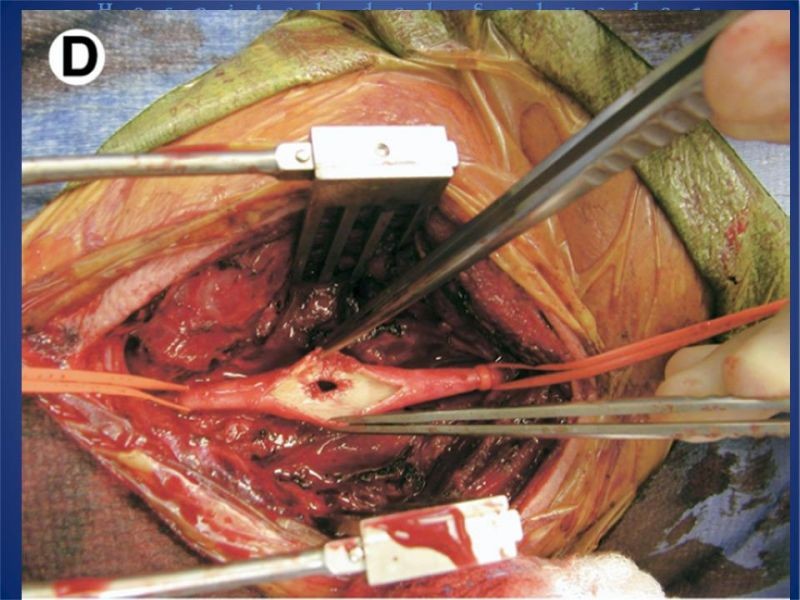 Diapositiva 23 de Trauma Vascular Cervical