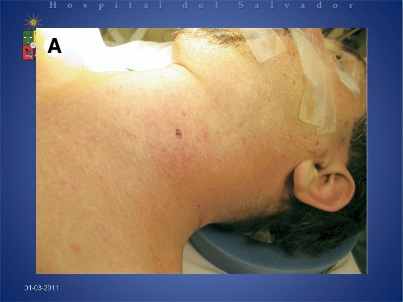 Diapositiva 20 de Trauma Vascular Cervical