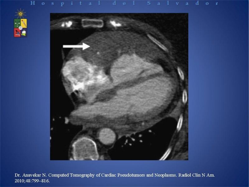Diapositiva 37 de Tumores Cardiacos