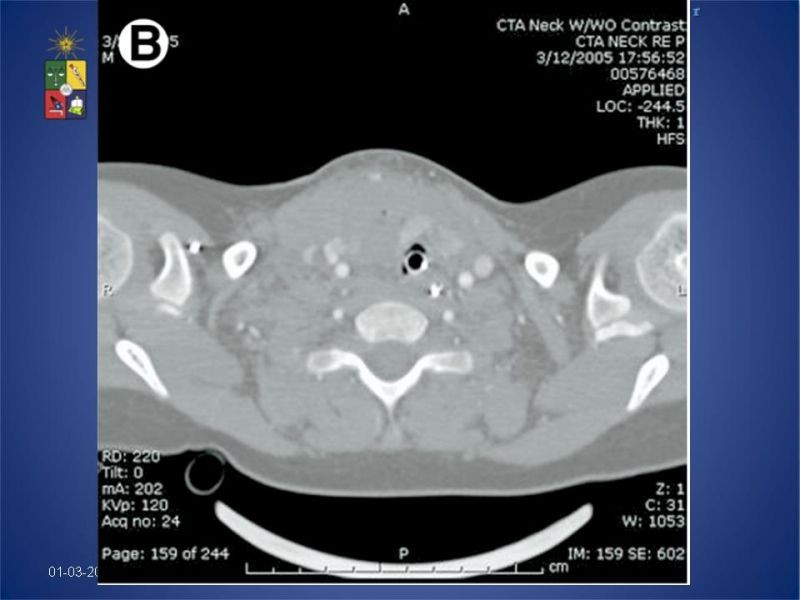 Diapositiva 21 de Trauma Vascular Cervical