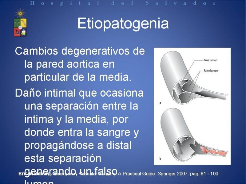 Diapositiva 4 de Manejo Disección Aórtica Tipo B