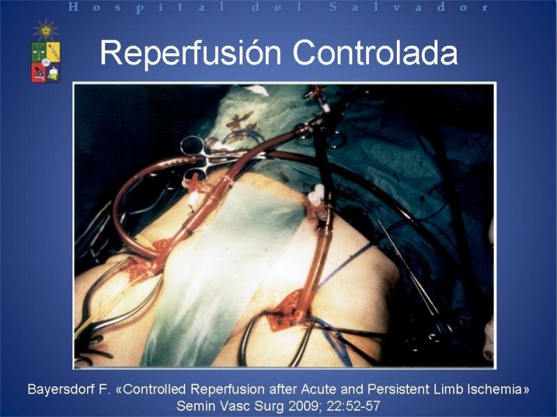 Diapositiva 15 de Síndrome de Reperfusión