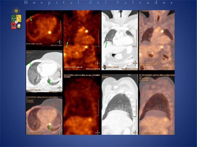 Diapositiva 16 de PET-CT en cáncer de Pulmón