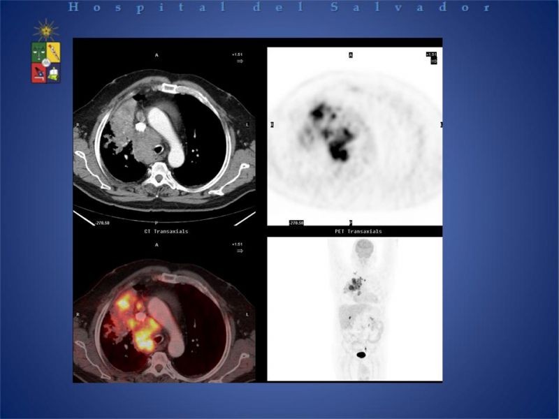 Diapositiva 15 de PET-CT en cáncer de Pulmón