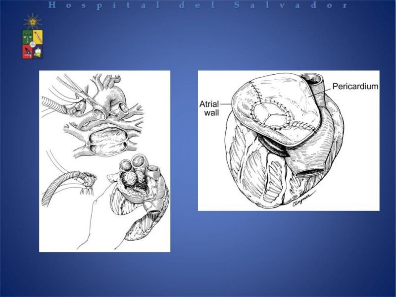 Diapositiva 32 de Tumores Cardiacos