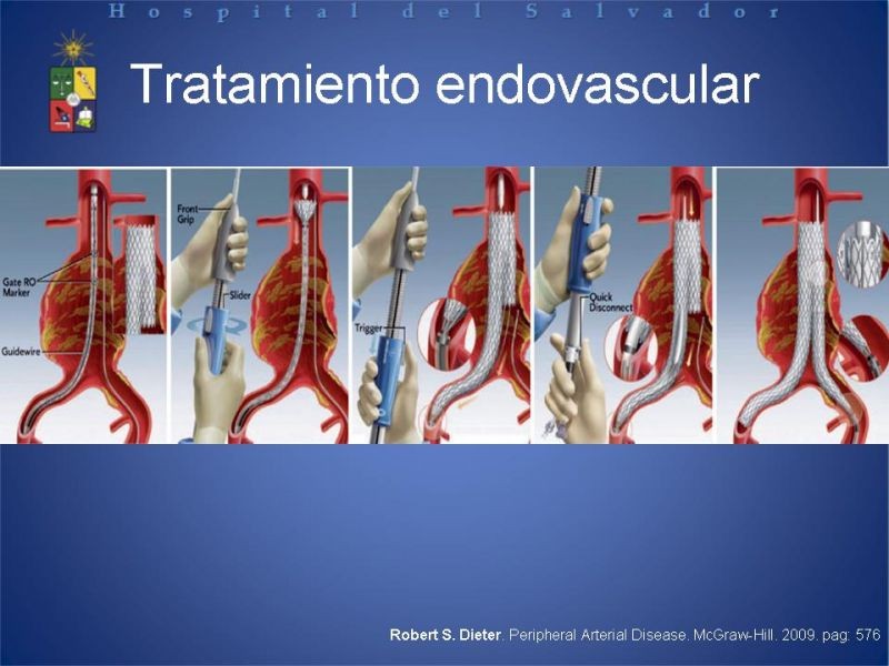 Diapositiva 14 de Manejo Disección Aórtica Tipo B