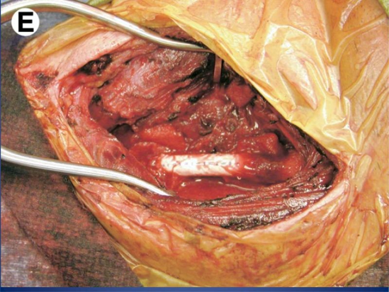 Diapositiva 24 de Trauma Vascular Cervical