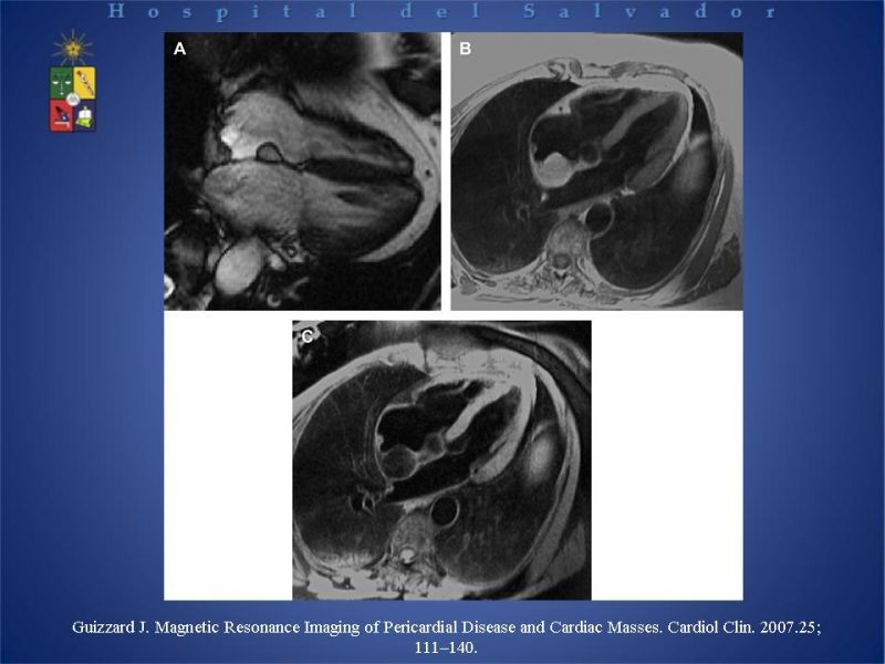 Diapositiva 19 de Tumores Cardiacos