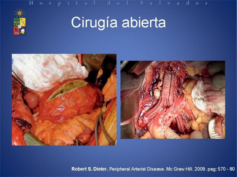 Diapositiva 16 de Manejo Disección Aórtica Tipo B