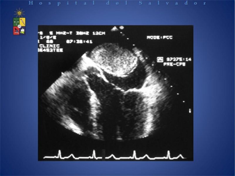 Diapositiva 12 de Tumores Cardiacos