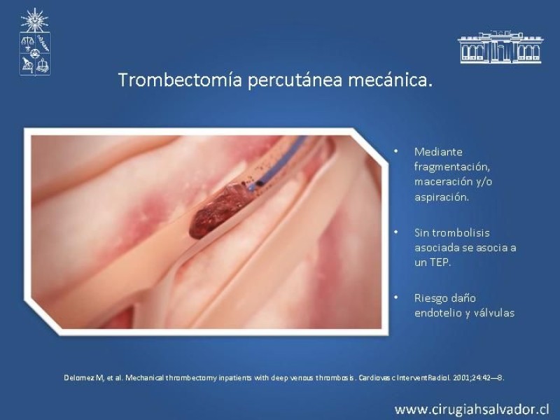 Diapositiva 15 de Manejo Quirúrgico de la TVP