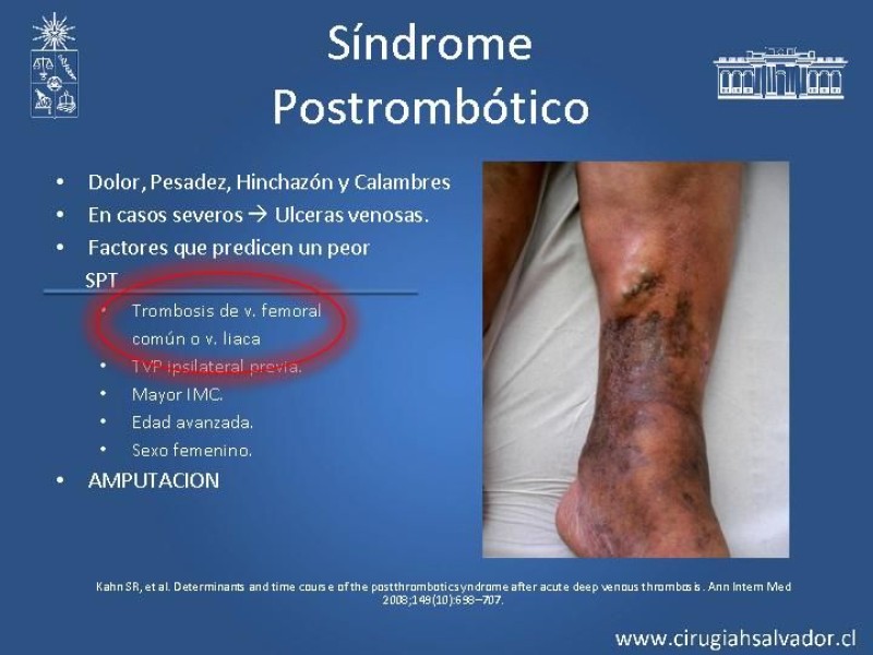 Diapositiva 9 de Manejo Quirúrgico de la TVP