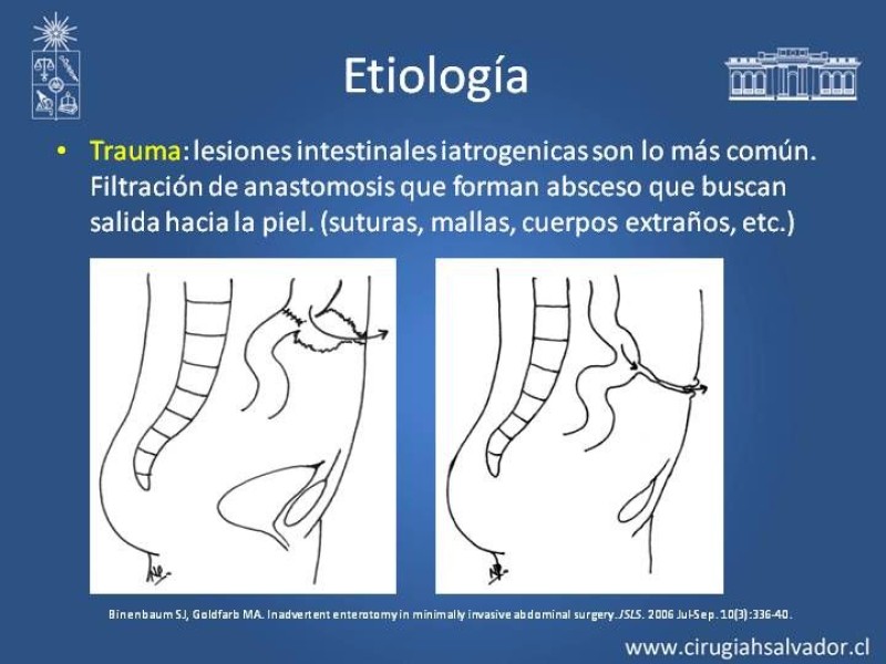 Diapositiva 3 de Fistulas Intestinales