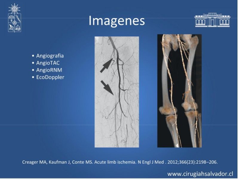 Diapositiva 10 de Isquemia Aguda
