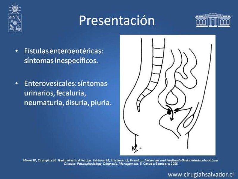 Diapositiva 8 de Fistulas Intestinales