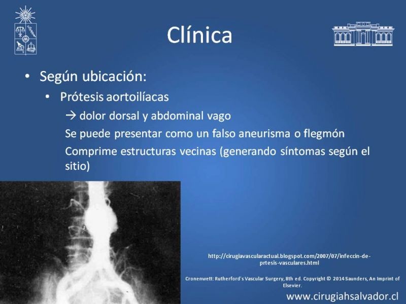 Diapositiva 13 de Infección de prótesis vasculares 