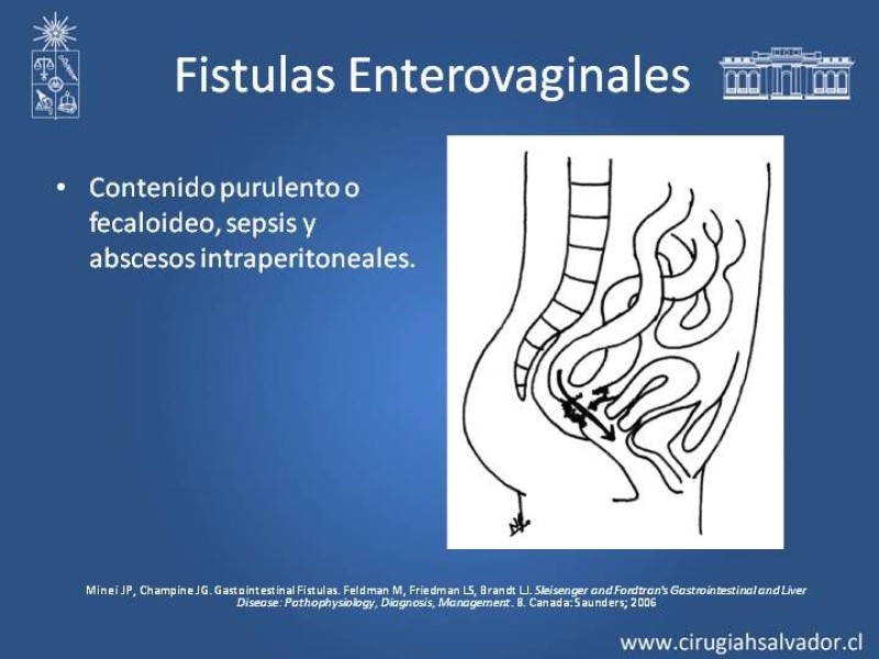 Diapositiva 10 de Fistulas Intestinales
