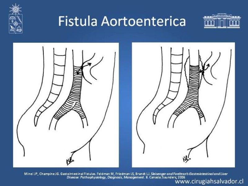Diapositiva 11 de Fistulas Intestinales