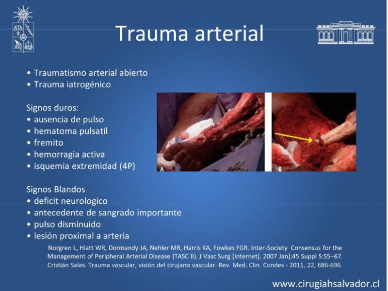 Diapositiva 6 de Isquemia Aguda