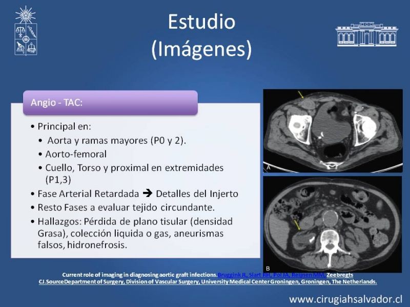 Diapositiva 17 de Infección de prótesis vasculares 