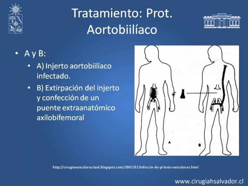 Diapositiva 32 de Infección de prótesis vasculares 