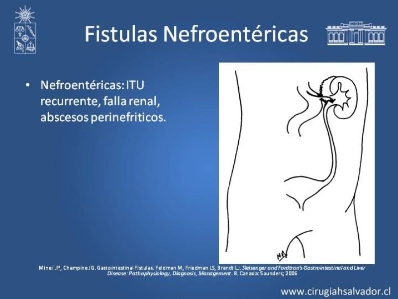 Diapositiva 9 de Fistulas Intestinales