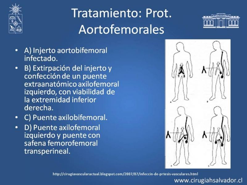 Diapositiva 33 de Infección de prótesis vasculares 