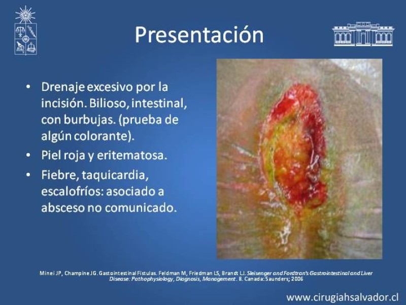 Diapositiva 7 de Fistulas Intestinales