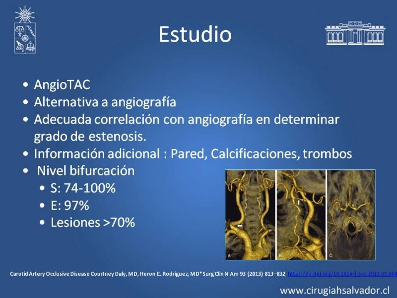 Diapositiva 16 de Estenosis Carotídea Asintomática