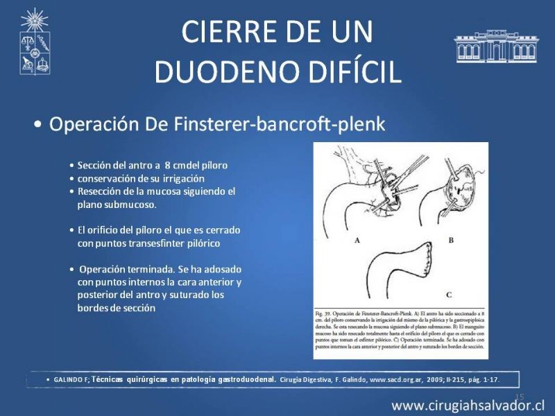 Diapositiva 14 de Manejo del muñón duodenal difícil