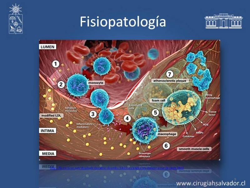 Diapositiva 8 de Estenosis Carotídea Asintomática