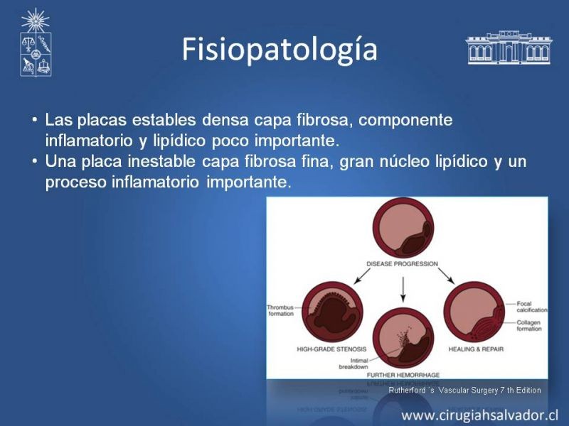 Diapositiva 9 de Estenosis Carotídea Asintomática
