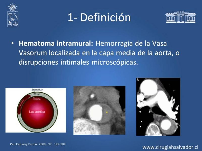 Diapositiva 8 de Síndrome Aórtico Agudo