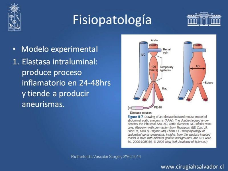 Diapositiva 7 de Aneurismas Periféricos