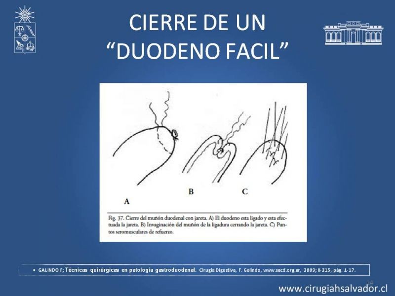 Diapositiva 13 de Manejo del muñón duodenal difícil