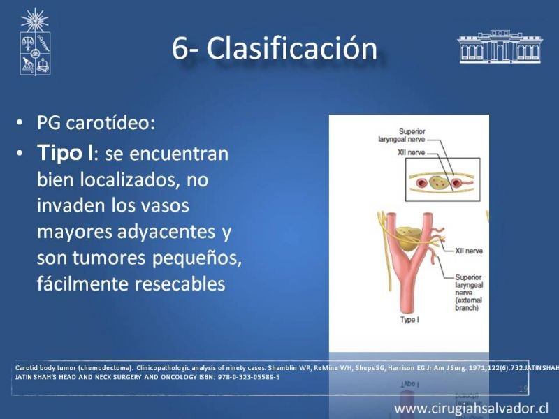 Diapositiva 18 de Paraganglioma cervical